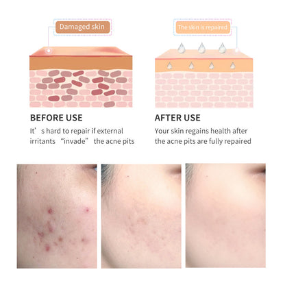 Acne Scar Removal Gel Tea - By BreyLee